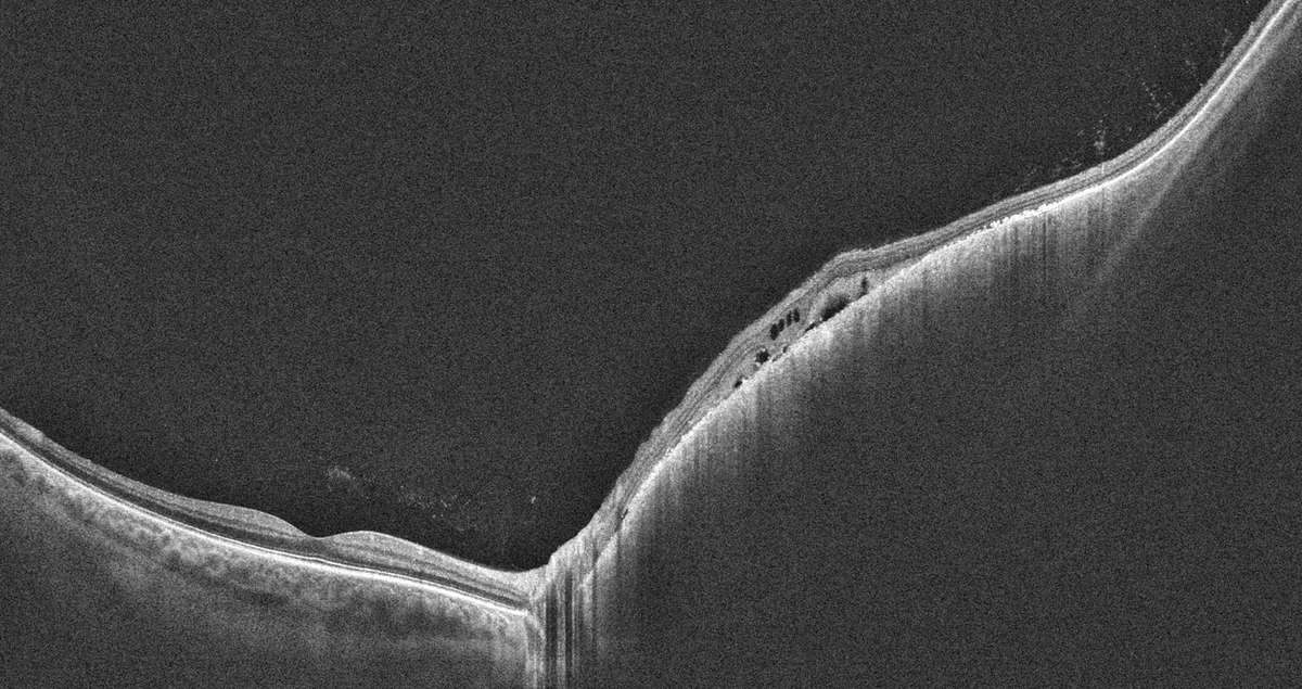 OCT Intalight montrant un épaississement choroïdien lié à un mélanome nasal avec fluide sous-rétinien